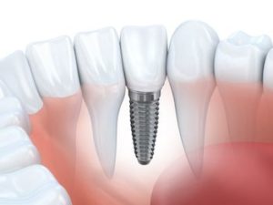 overland park dental implants