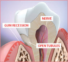 Sensitive Teeth Cutaway Pic