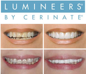 Lumineers Teeth