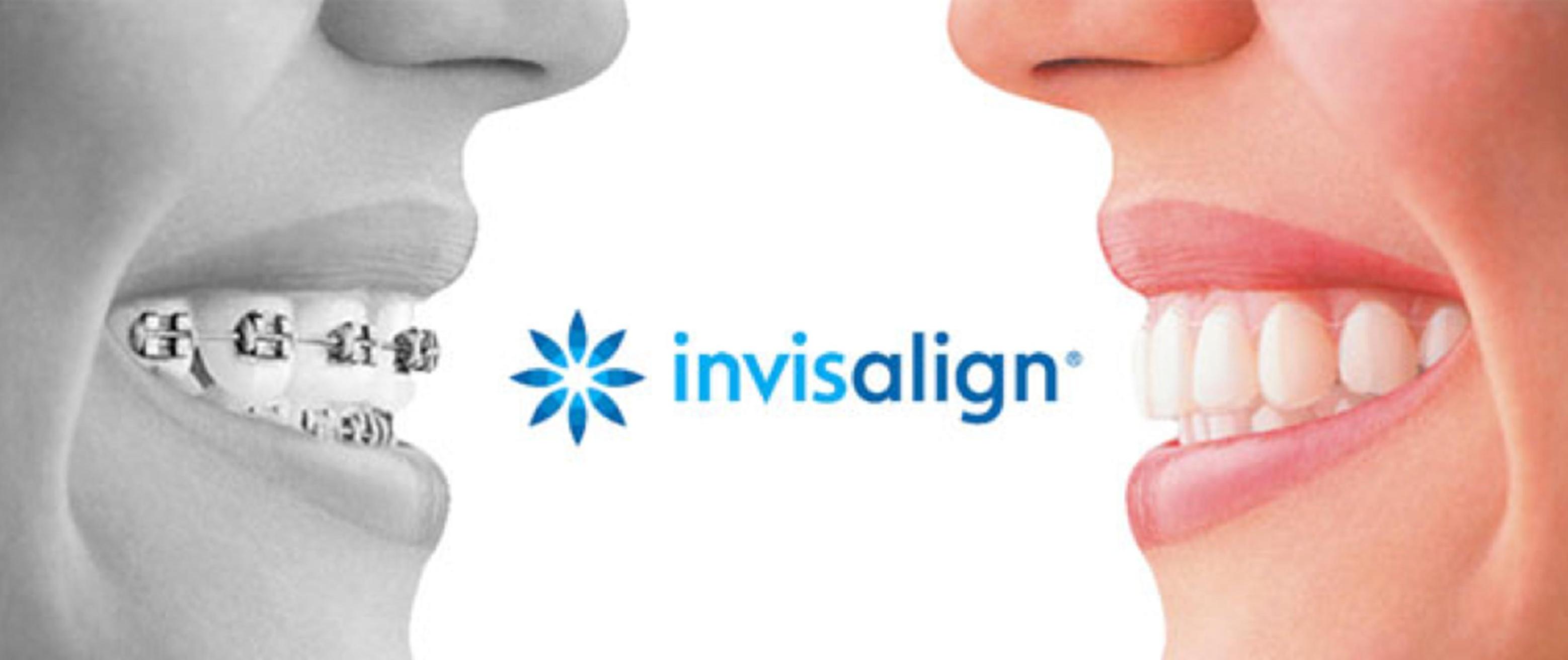 What's the cost difference between traditional braces and Invisalign? «  Smiles by White