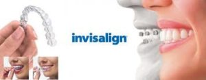 invisalign-vs-braces