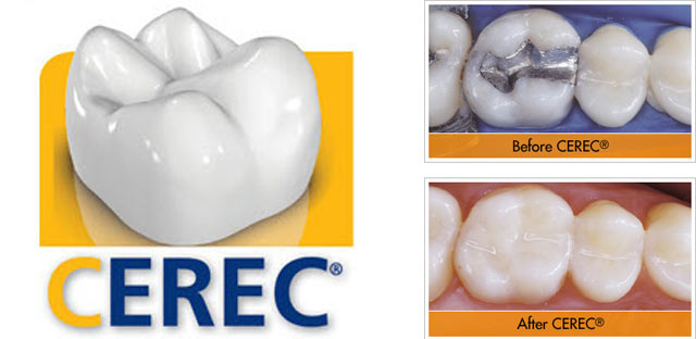 cerec crowns near me