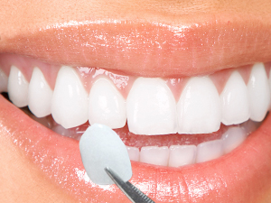 Reasons to Get Porcelain Veneers at Overland Park Dentistry