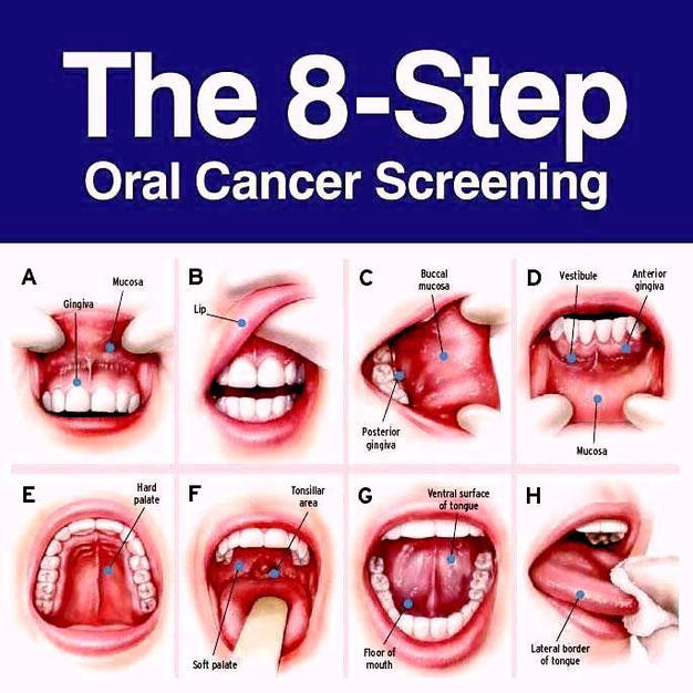 What Do The Early Stages Of Lip Cancer Look Like