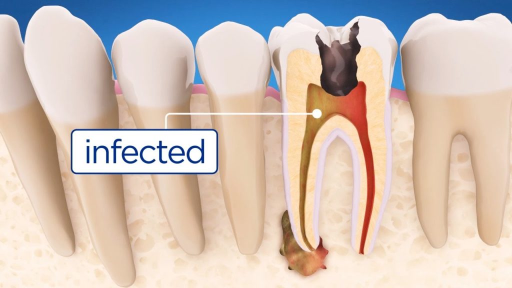 can a root canal be done on a canine tooth