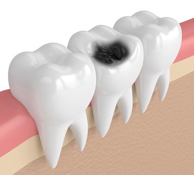 severe molar decay