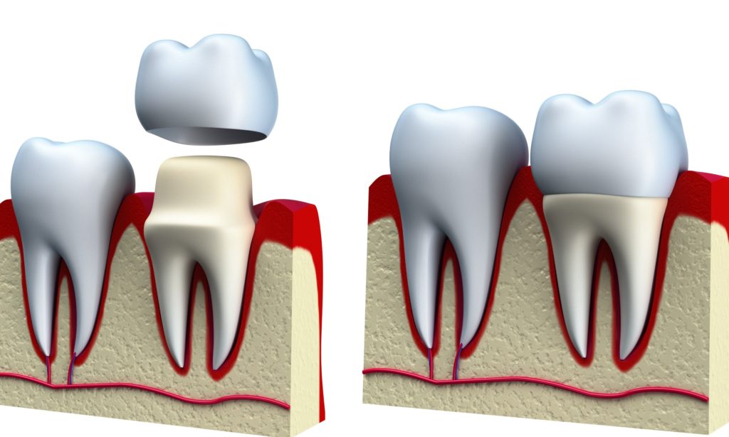 Avoid These Missteps When Undertaking Invisalign Treatment