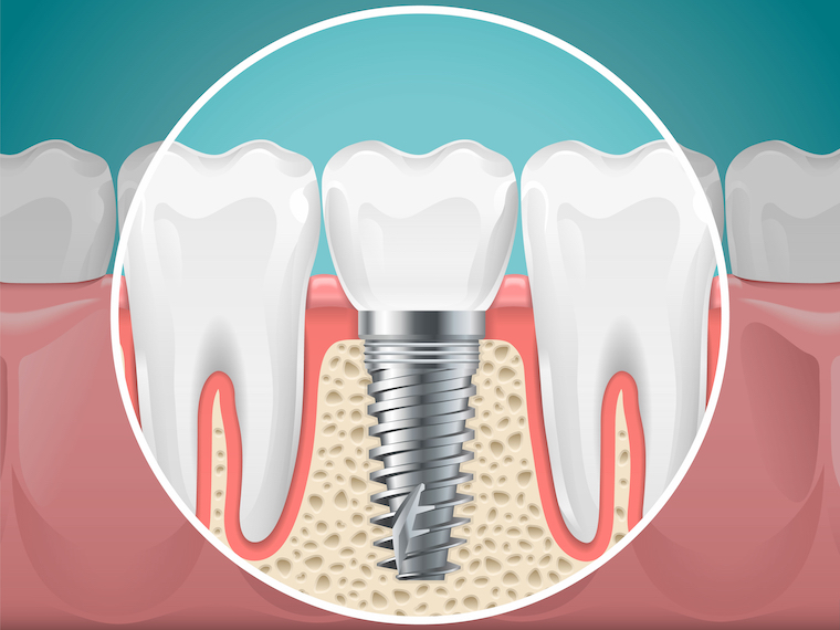 Why Dental Implants Are Better Than Other Tooth Repair » St. Louis